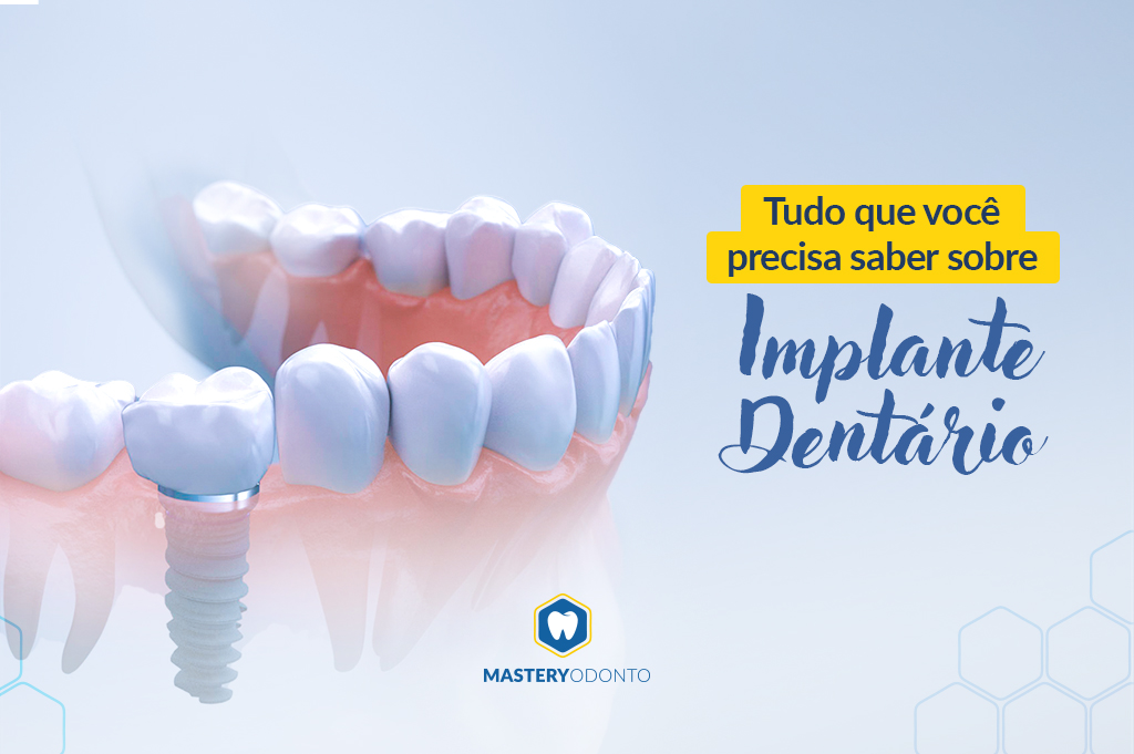 implante dentário, informação, mastery odonto